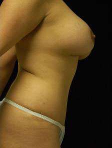 Abdominoplasty