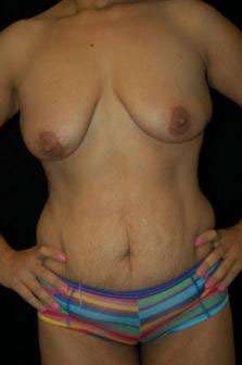 Abdominoplasty