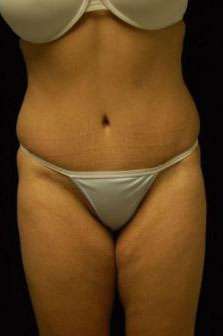 Abdominoplasty