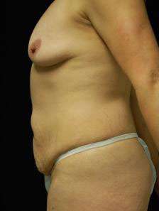 Abdominoplasty