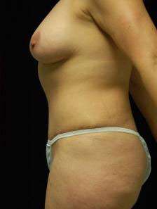 Abdominoplasty