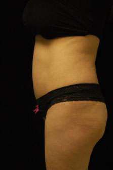 Abdominoplasty