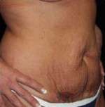 Abdominoplasty
