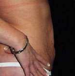 Abdominoplasty