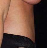 Abdominoplasty