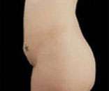 Abdominoplasty