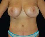Abdominoplasty
