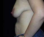 Abdominoplasty