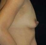 Breast Round, Saline