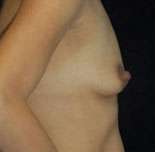 Breast Round, Saline