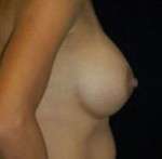 Breast Round, Saline