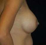 Breast Round, Saline