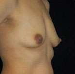 Breast Round, Saline