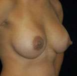 Breast Round, Saline