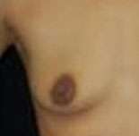 Breast Round, Saline