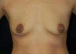 Breast Round, Saline