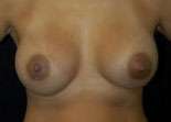 Breast Round, Saline