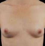 Breast Round, Saline
