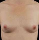 Breast Round, Saline