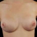 Breast Round, Saline