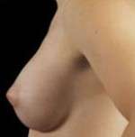 Breast Round, Saline