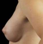 Breast Round, Saline