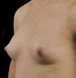 Breast Round, Saline