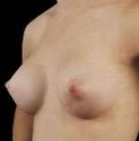 Breast Round, Saline