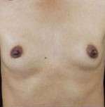Breast Round, Saline