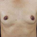 Breast Round, Saline