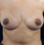 Breast Round, Saline