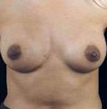 Breast Round, Saline