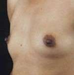 Breast Round, Saline