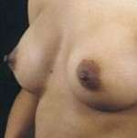 Breast Round, Saline