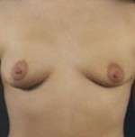 Breast Round, Saline