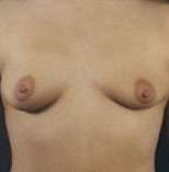 Breast Round, Saline