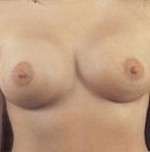 Breast Round, Saline