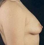 Breast Round, Saline