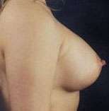 Breast Round, Saline