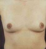 Breast Round, Saline