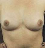 Breast Round, Saline