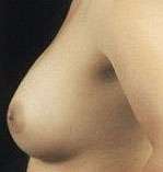 Breast Round, Saline