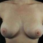 Breast Round, Saline
