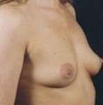 Breast Round, Saline