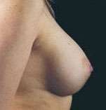 Breast Round, Saline