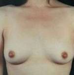 Breast Round, Saline