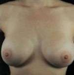 Breast Round, Saline