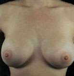 Breast Round, Saline