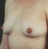 Breast Round, Saline