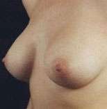 Breast Round, Saline
